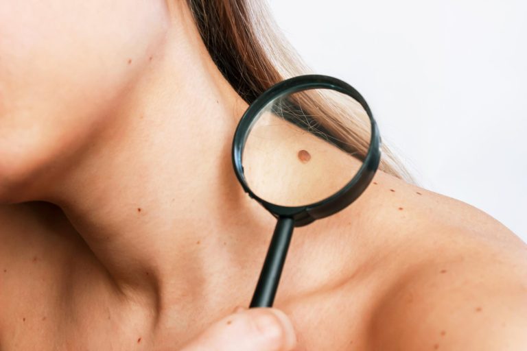 closeup-big-mole-young-womans-neck-magnified-with-magnifying-glass