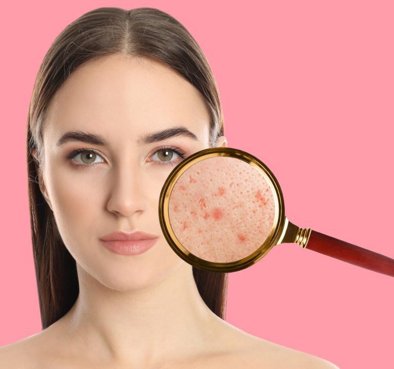 young-woman-with-acne-problem-pink-background-skin-magnifying-glass