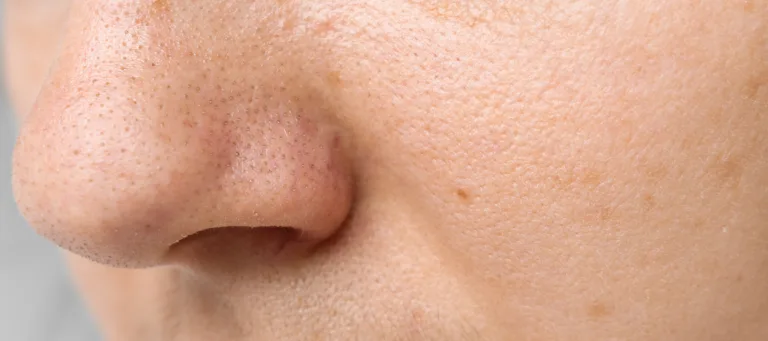 Acne, pimples on the nose close-up. Problematic facial skin, poor hygiene. Beauty and body care concept