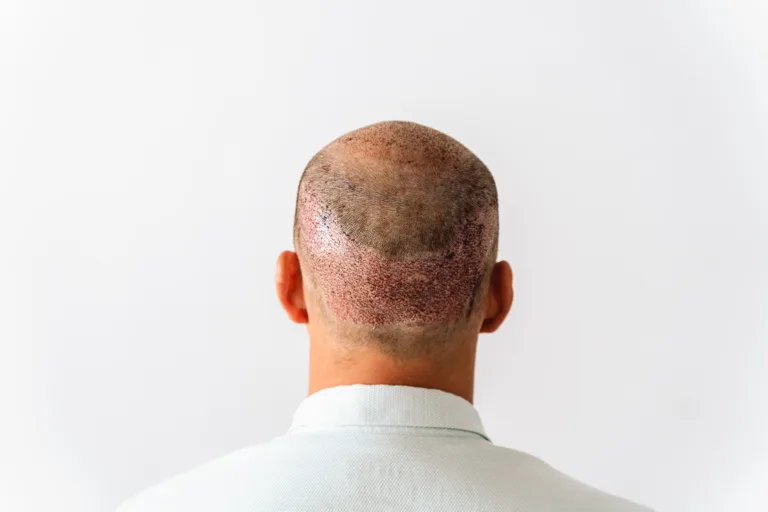 After hair transplantation surgical technique that moves hair follicles. Young bald man in bandage with hair loss problems