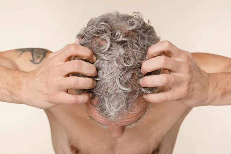 Grey-haired caucasian mature middle-aged man showing hairline with dandruff, hair loss problems