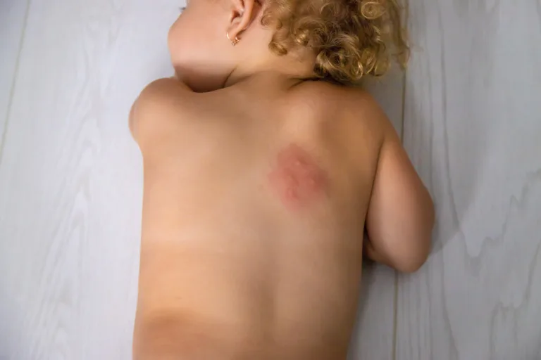 Mosquito bites on a child back. Selective focus